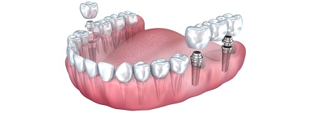 ایمپلنت چند دندان کنار هم, ایمپلنت چند دندان, اصول جایگذاری ایمپلنت چند دندان