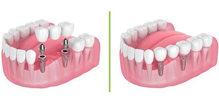 ایمپلنت دو دندان در کنار هم, ایمپلنت کردن بیش از دو دندان, مزایای ایمپلنت