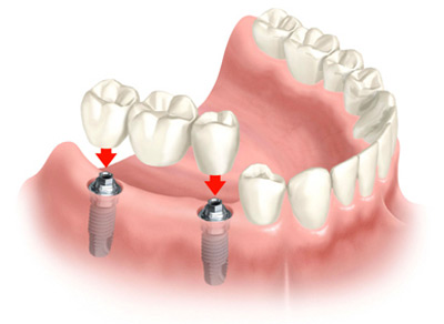  مضرات ایمپلنت دندان, مراقبت از ایمپلنت دندان