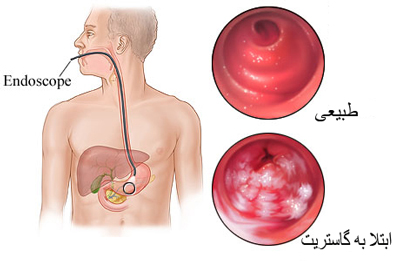  علایم التهاب در معده, بیماری کرون