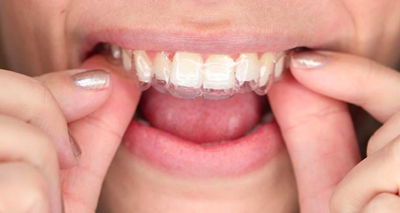 ارتودنسی نامرئی عکس, ارتودنسی نامرئی دندان