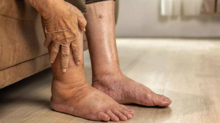 علائم سرطان پانکراس در پاها, درد پا و سرطان پانکراس