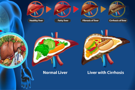 رژیم غذایی سیروز کبدی, رژیم غذایی برای سیروز کبدی