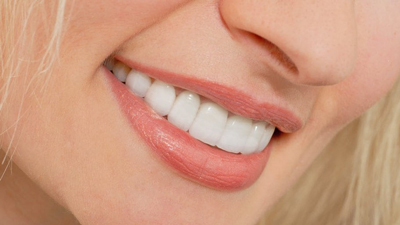 لمینت دندان چیست, معایب لمینت دندان