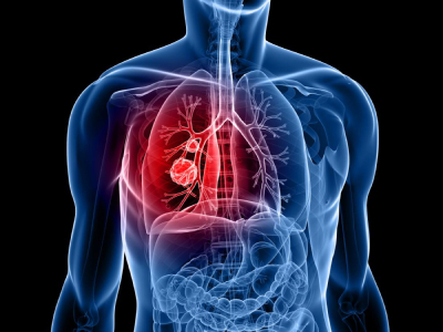مهمترین علامت سرطان ریه, برای جلوگیری از سرطان ریه