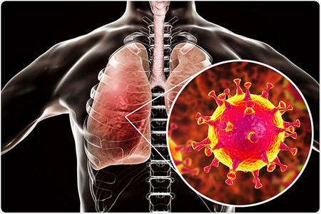 علائم عفونت ریه چیست, درمان عفونت ریه