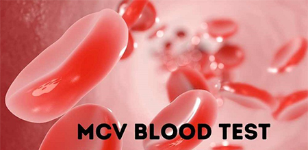 mcv ازمایش, دلایل پایین آمدن mcv خون, نتیجه ازمایش خون mcv