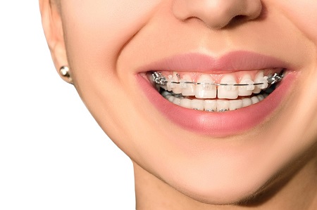 میدلاین دندان, میدلاین دندان چیست, اهمیت توجه به میدلاین دندان