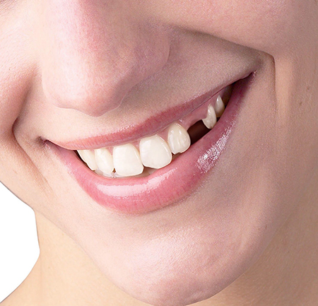 هیپودنشیا, علت غیبت دندانی, جلوگیری از غیبت دندانی