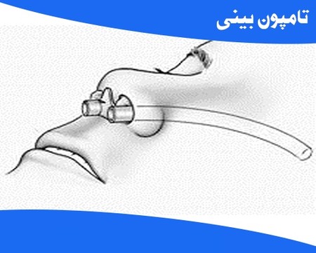 دلایل استفاده از تامپون بینی, کاربرد تامپون بینی, زمان برداشتن تامپون بینی