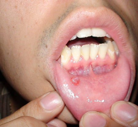 جلوگیری از موکوسل دهانی, درمان موکوسل دهانی, علایم موکوسل دهانی