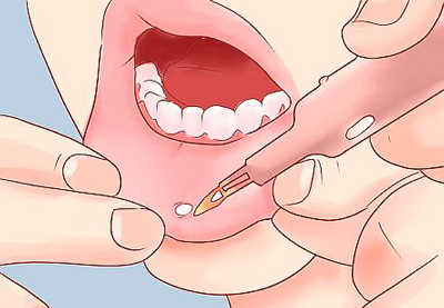 درمان فوری زخم دهان و لثه, درمان برای زخم دهان