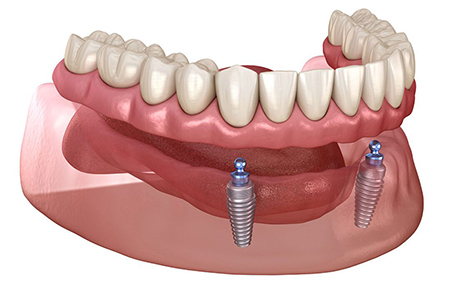 معایب استفاده از اوردنچر, مراقبت‌های بعد از اوردنچر, بهبود عملکرد دندان‌ها