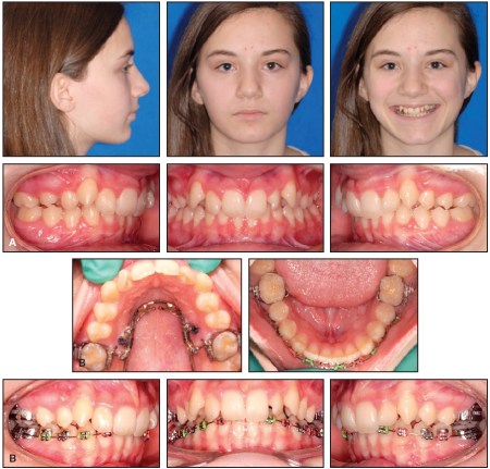 ارتودنسی های نامرئی,پوسیدگی دندان,درمان های ارتودنسی