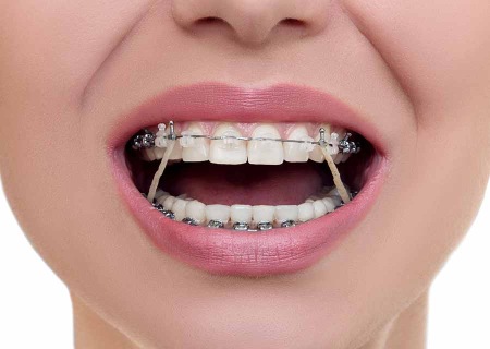 کش ارتودنسی چیست, انواع کش ارتودنسی, ویژگی کش ارتودنسی