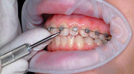 زیبایی دندان بدون ارتودنسی