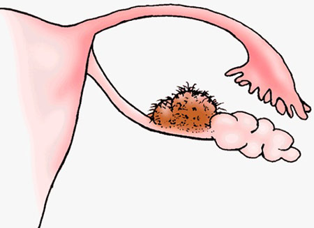 کیست مویی تخمدان,کیست درموئید,علائم کیست مویی تخمدان