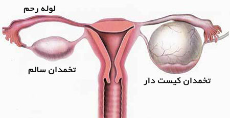 کیست های تخمدانی,درمان کیست های تخمدانی,پیشگیری از کیست های تخمدانی