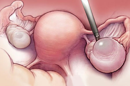 توده های تخمدانی,کیست های تخمدانی,درمان توده های تخمدانی در زنان
