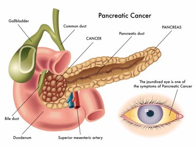 سرطان پانکراس بدخیم, علایم سرطان لوزالمعده