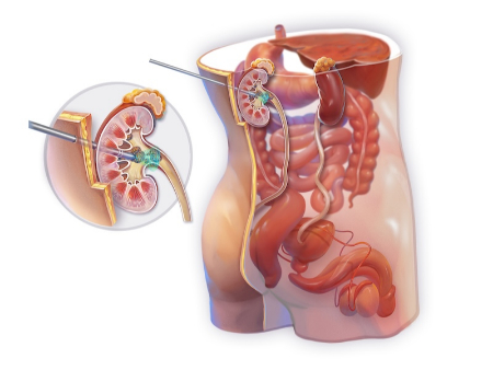نفرولیتوتومی از راه پوست, عمل PCNL