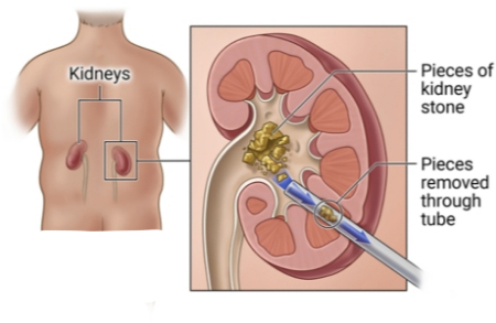 نفرولیتوتومی از راه پوست, عمل PCNL