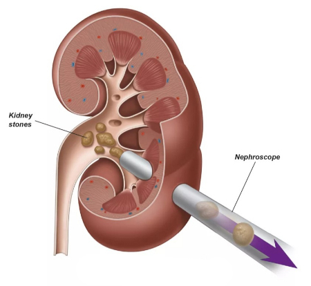 نفرولیتوتومی از راه پوست, عمل PCNL