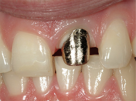 ترمیم دندان های آسیب دیده, پوسیدگی دندان, ساختار دندان