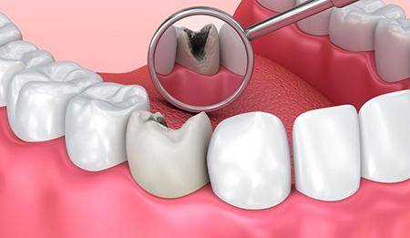 پست و کور دندان چیست, فواید  پست و کور دندان, نحوه انجام پست و کور دندان