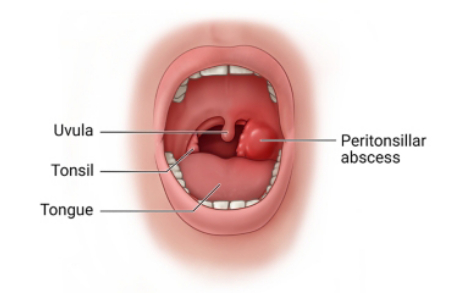 علائم، علل و روش‌های تشخیص آبسه پره تونسیلار