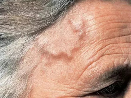 بیرون زدگی رگ پیشانی, بیرون زدگی رگ شقیقه
