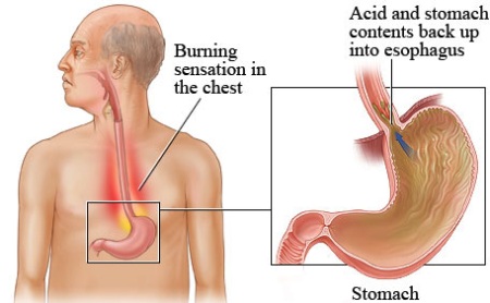 آیا رفلاکس معده باعث بوی بد دهان میشود