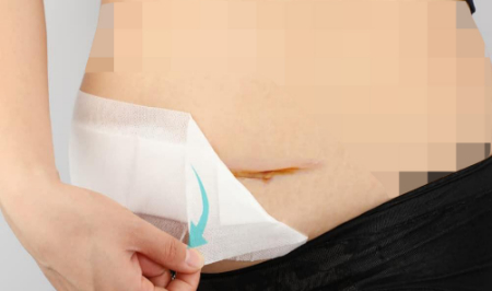 پانسمان زخم را معمولاً هر ۲۴ تا ۴۸ ساعت یکبار تعویض کنید جدا کردن گاز استریل از زخم, استفاده از سرم برای جدا کردن گاز استریل