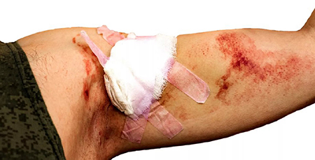 در صورت درد شدید یا چسبندگی زیاد، حتماً با پزشک مشورت کنید جدا کردن گاز استریل از زخم, استفاده از سرم برای جدا کردن گاز استریل