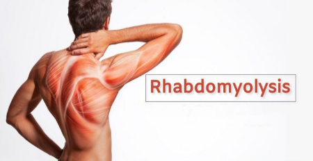 رابدومیولیز چیست, علائم رابدومیولیز