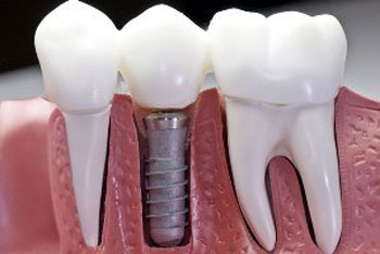 مراحل ایمپلنت دندان, ایمپلنت کامل دندان