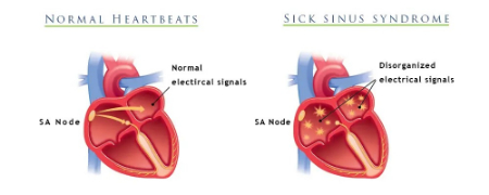 سندرم سینوس بیمار؛ بیماری قلبی که می تواند زندگی شما را تهدید کند