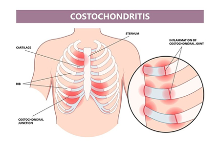 کوستوکندریت, علت ورم قفسه سينه چیست, درد قفسه سینه یکی از نشانه های کوستوکندریت