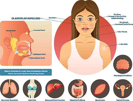 سندرم شوگرن چیست, علائم و درمان بیماری سندرم شوگرن, کمبود روی سندرم شوگرن