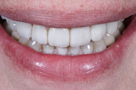 عوارض کامپوزیت دندان, معایب کامپوزیت دندان
