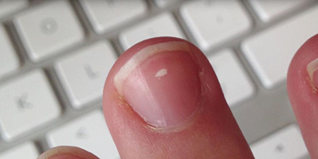علت ایجاد لکه های سفید روی ناخن ها از چیست , لکه های سفید روی ناخن پا , از بین بردن لکه های سفید ناخن