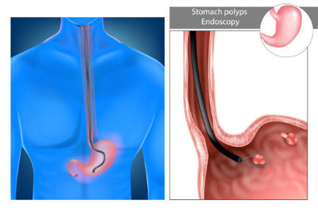 پولیپ معده, برداشتن پولیپ معده با آندوسکوپی