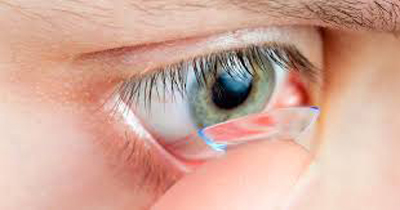 درمان نزدیک بینی چشم با روش غیرجراحی ارتوکراتولوژی