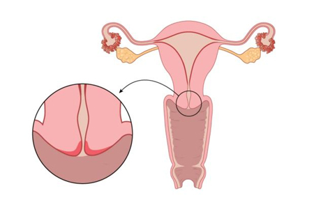 دهانه رحم، بیماری های دهانه رحم