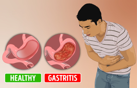 آموزش بیماری گاستریت،حالت تهوع در گاستریت