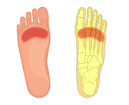 درمان متاتارسالژی, علت درد پنجه پا, درمان درد پنجه پا در طب سنتی