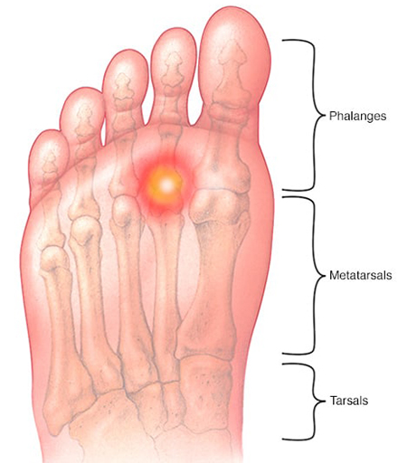  علت درد پنجه پا, درمان درد پنجه پا در طب سنتی, علت درد زیر انگشتان کف پا