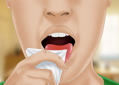 سرفه و طعم خون در دهان, خونریزی دهان ناشی از التهاب لثه‌ها