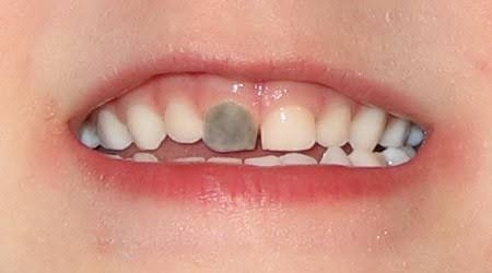تغییر رنگ دندان ها بعد از عصب کشی, دلیل تغییر رنگ دندان بعد از عصب کشی, علل تغییر رنگ دندانها پس از عصب کشی