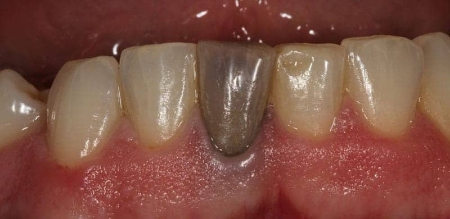 تغییر رنگ دندان ها بعد از عصب کشی, دلیل تغییر رنگ دندان بعد از عصب کشی, تغییر رنگ شدید دندان 